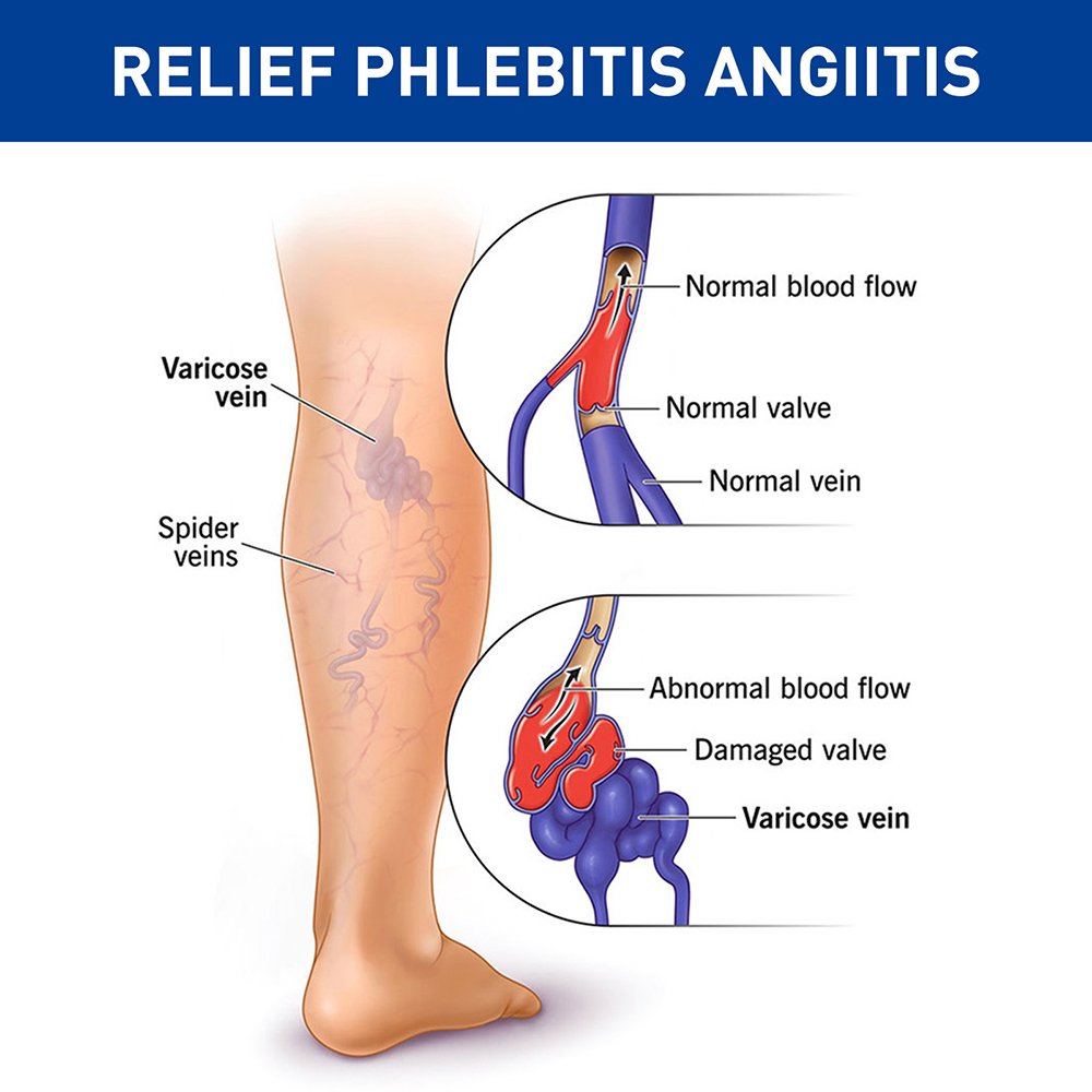 Qian 1pair Varicose Veins Socks Treat Phlebitis Vasculitis